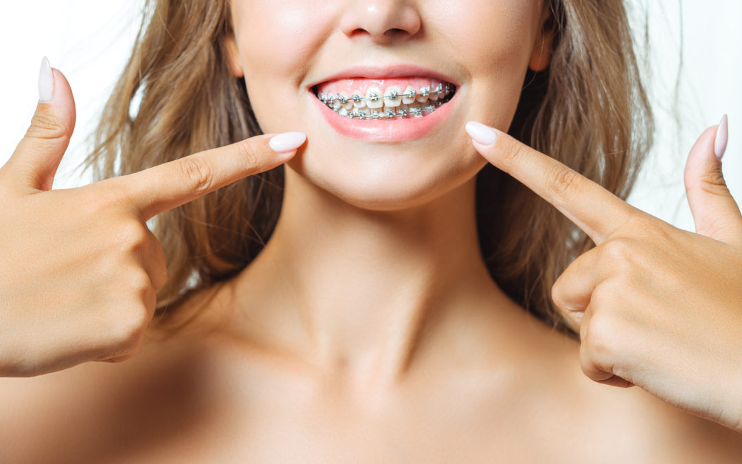 Ortho and Braces in Miami