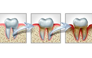 Understanding Gum Disease Miami Lakes and Pembroke Pines