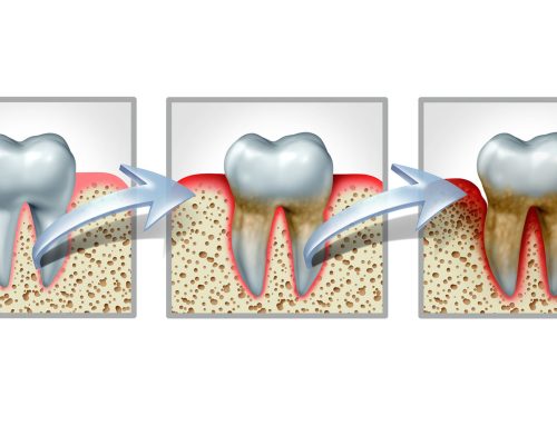 Understanding Gum Disease