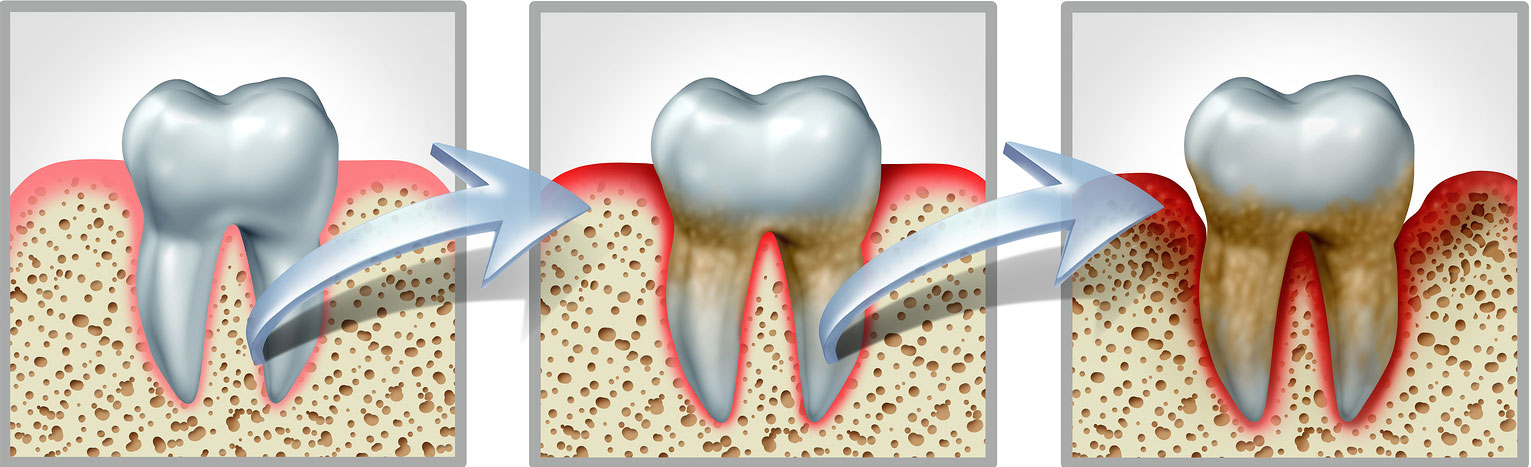 Understanding Gum Disease Miami Lakes and Pembroke Pines