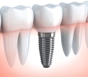 Dental Implants